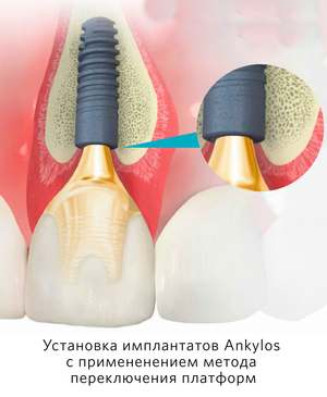 Субкрестальная установка имплантов