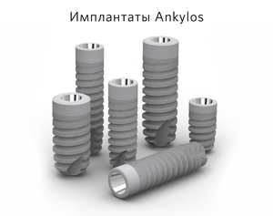 Импланты серии Ankylos для установки в Витанике
