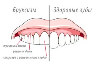 здоровые зубы и стертые при бруксизме