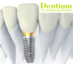 Имплантаты Dentium для протезирования зубов