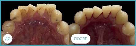 Профессиональная чистка зубов: до и после