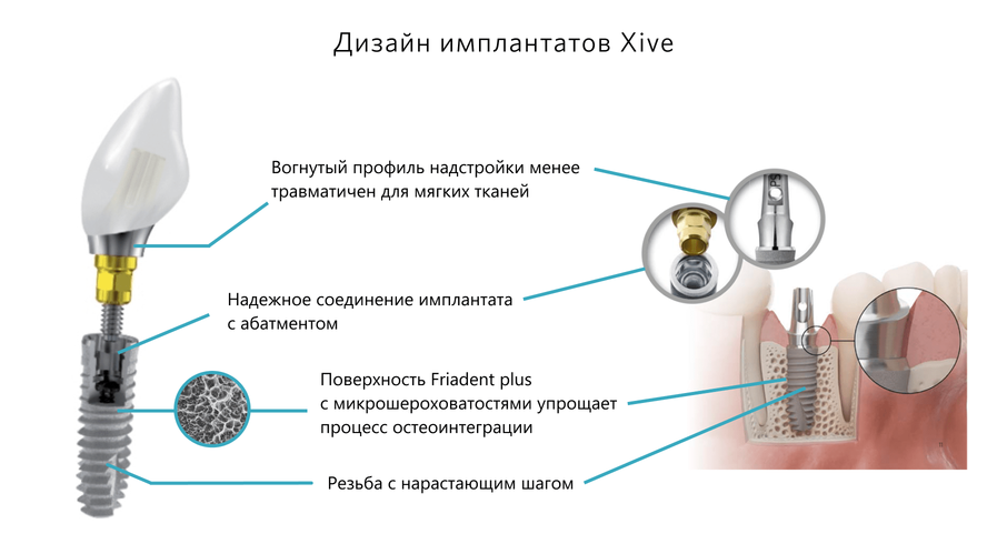 Дизайн имплантатов Xive для восстановления зубов