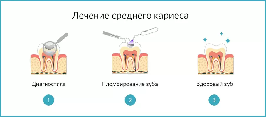 Лечение среднего кариеса