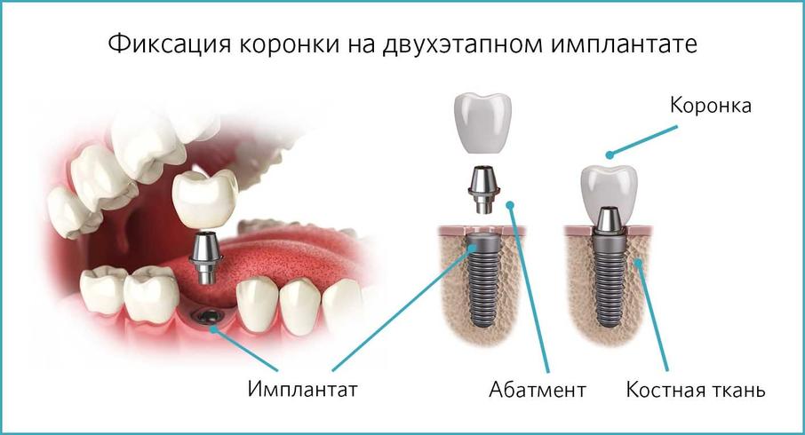 Фиксация коронок на имплантате