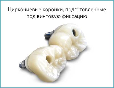 Циркониевые коронки с винтовой фиксацией на имплантаты