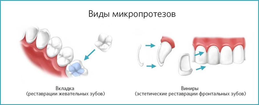 Виды микропротезирования