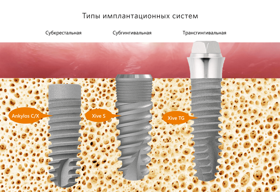Типы имплантационных систем для установки в Витанике