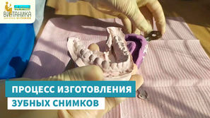 Создание зубного слепка