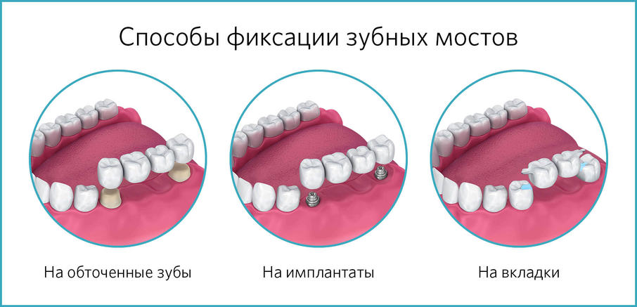 Способы фиксации зубных мостов