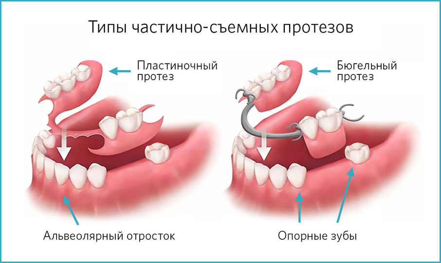Типы частично-съемных протезов поликлиники "Витаника"