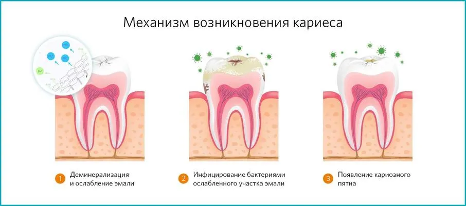 Причины образования кариеса