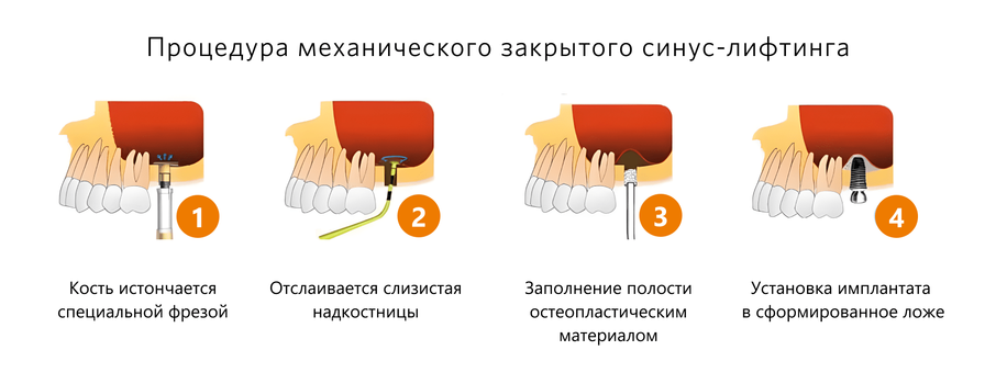 Закрытый механический синус-лифтинг