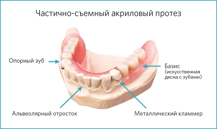 Конструкция и фиксация частично-съемного протеза