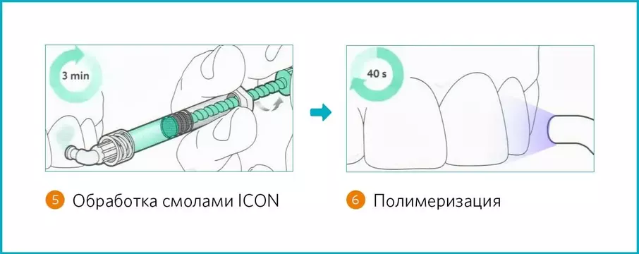3 этап лечения на Icon