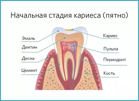 Начальная стадия развития кариеса
