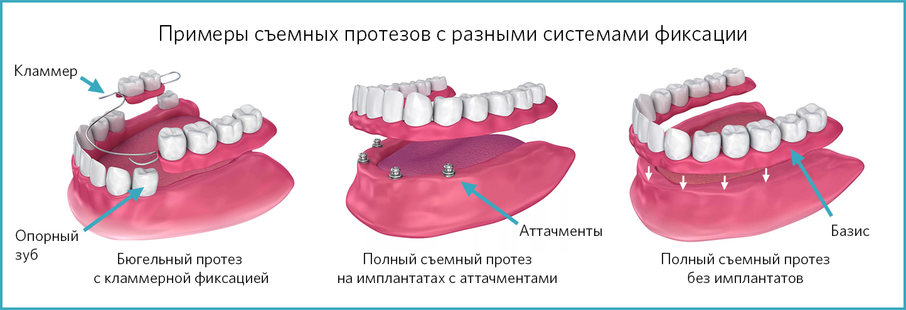 Различные виды съемных протезов
