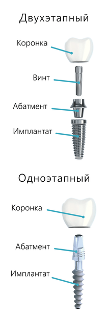 Виды имплантатов