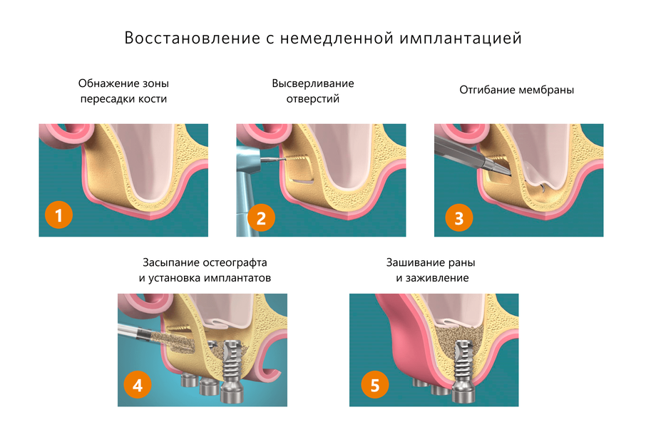 Синус-лифтинг с немедленной имплантацией