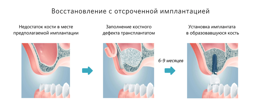 Синус-лифтинг с отсроченной имплантацией
