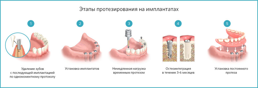 Этапы установки протезов на имплантатах
