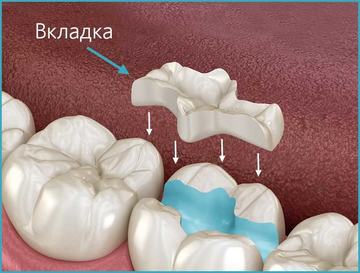 Установка зубной вкладки