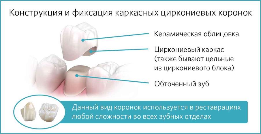 Конструкция и установки циркониевых коронок