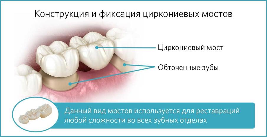 Конструкция и фиксация циркониевого моста