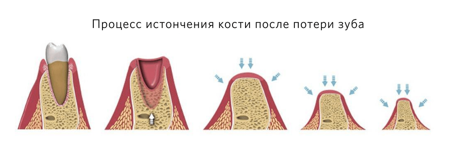 Процесс истончения кости после потери зуба