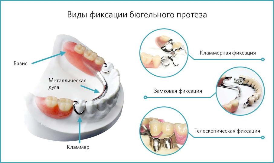 Варианты систем фиксации бюгельных протезов