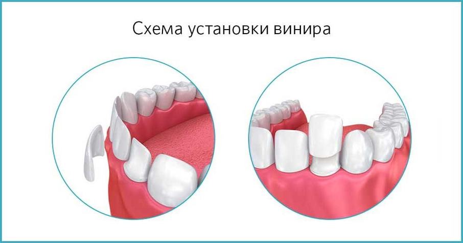 Установка виниров на передние зубы