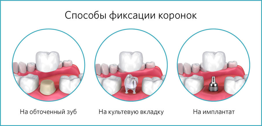 Варианты фиксации коронок