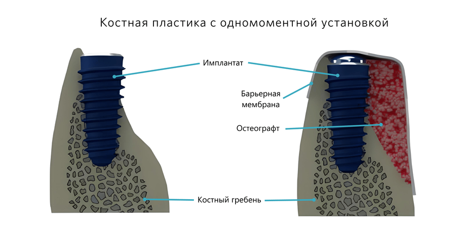 Костная пластика с одновременной имплантацией