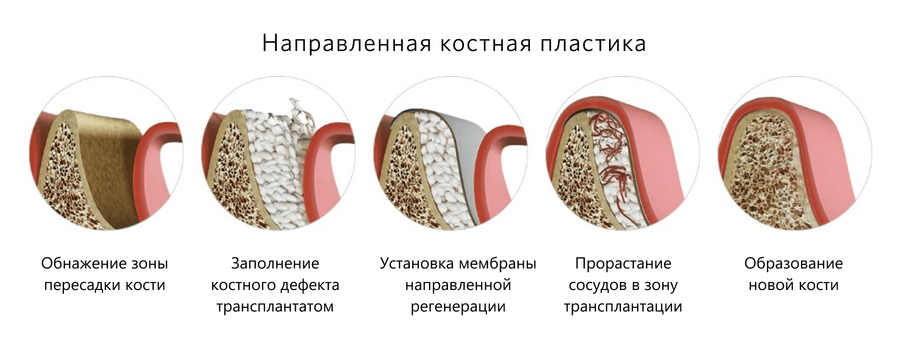 Этапы направленной костной регенерации