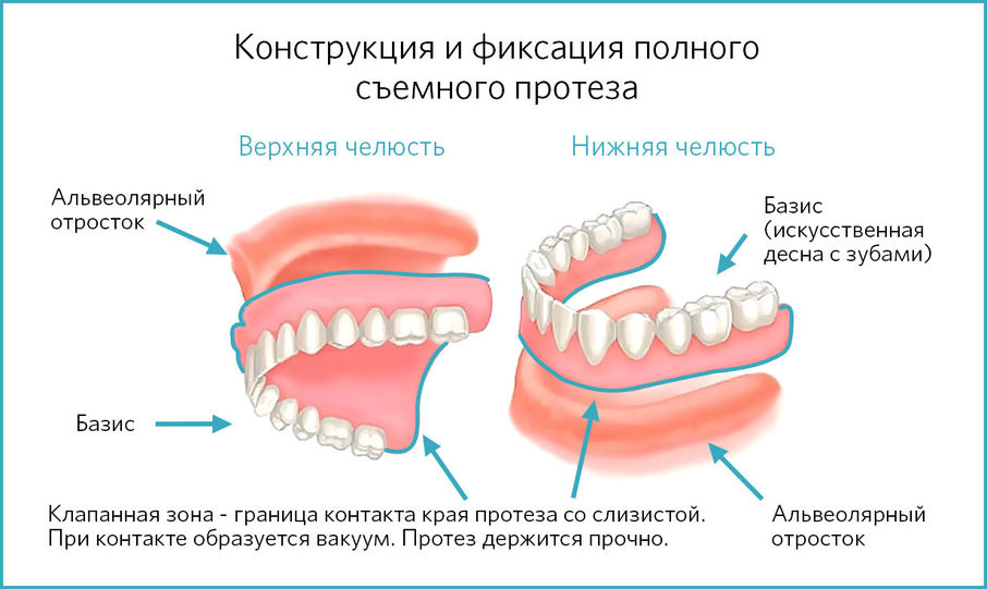 Схема конструкции и фиксации полного съемного протеза
