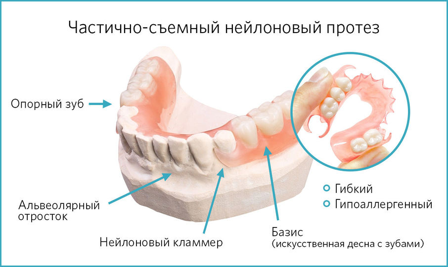 Конструкция и фиксация частично-съемного протеза из нейлона