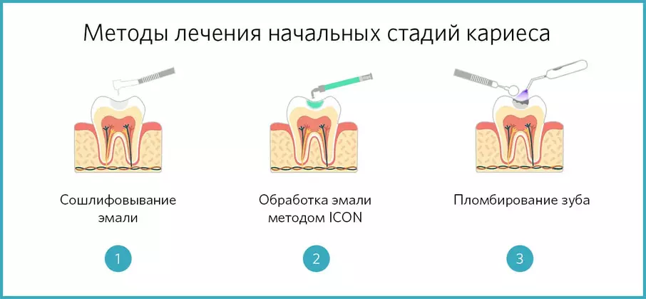 Методы лечения начальных стадий кариеса