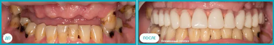 Имплантация по протоколу All on 6: До и после