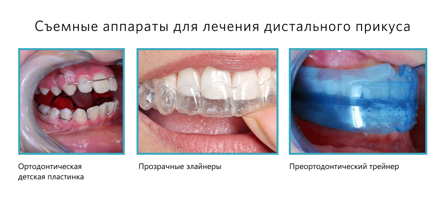 Съемные аппараты для лечения дистального прикуса Съемные аппараты для лечения дистального прикуса