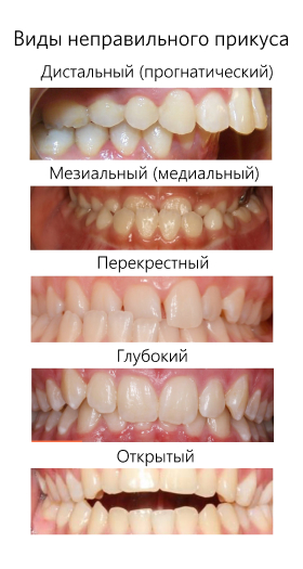 Разные виды неправильного прикуса